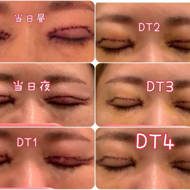 40代眼瞼下垂手術ダウンタイム4日目レポ♡眼瞼下垂、二重切開、目の上のたるみ取り、脂肪取り