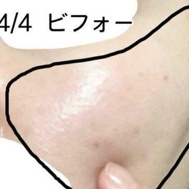 シミ取りレーザー3週間後