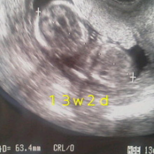 13w3d 入院生活5日目(久々にエコー写真)