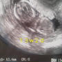 13w3d 入院生活5日目(久々にエコー写真)