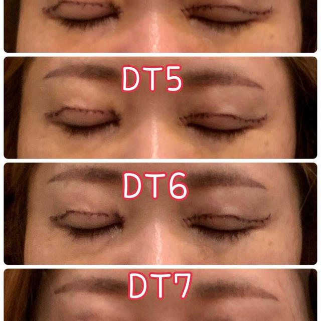抜糸後1日目二重整形手術DT8日目までの経過レポ♡眼瞼下垂、二重切開、目の上のたるみ取り、