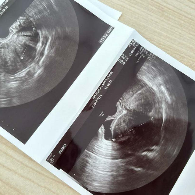 検査の結果がまさかのがんの疑い：子宮筋腫がわかるまでの経緯～体験談その⑫