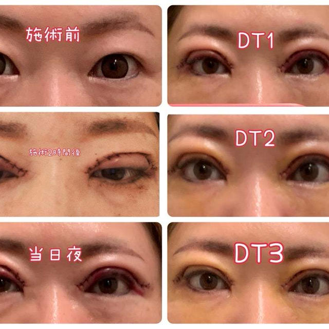 二重全切開DT3日目レポ♡眼瞼下垂、二重切開、目の上のたるみ取り、脂肪取り