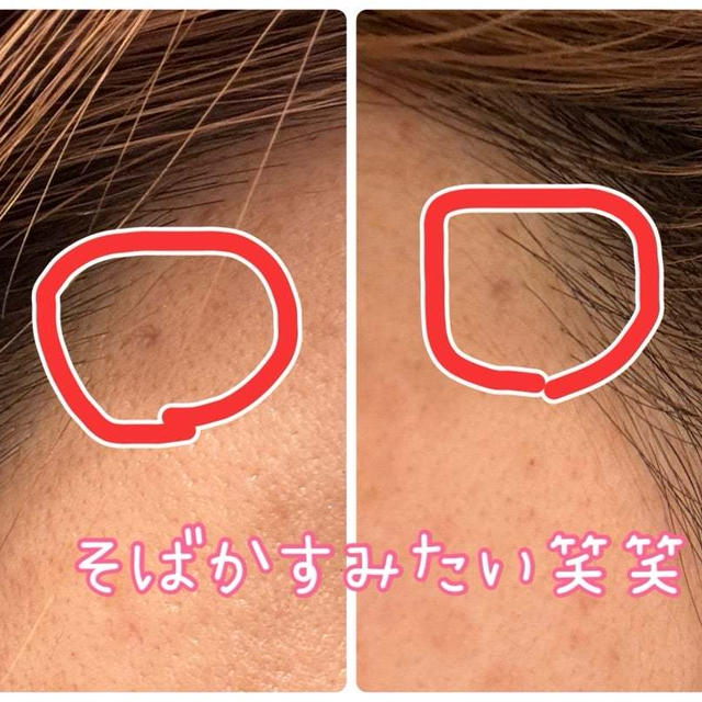 加齢と戦う日々♡ずっとリフトアップしている状態がいい♡糸リフトと額のヒアルロン酸注入