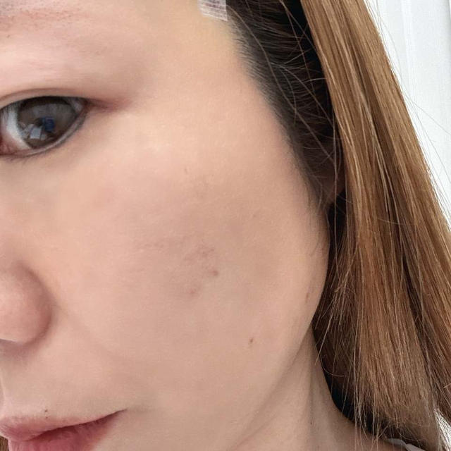どこからどこまでが美容整形？糸リフトとエラボトックスやってきました！
