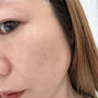 どこからどこまでが美容整形？糸リフトとエラボトックスやってきました！