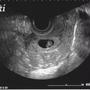 7w5d　バルトリン腺膿腫
