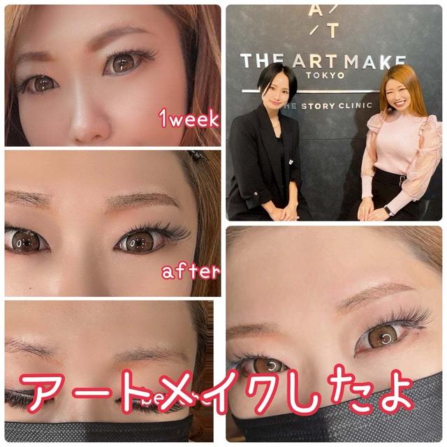 日本で眉毛のアートメーク♡体験談と病院選びのコツ