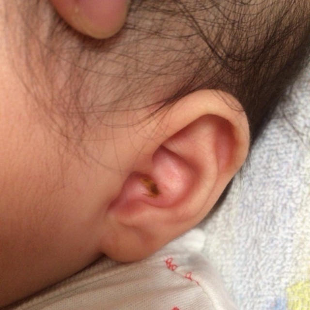 赤ちゃん 耳垢