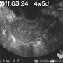 4w5d　胎嚢らしきもの発見!!