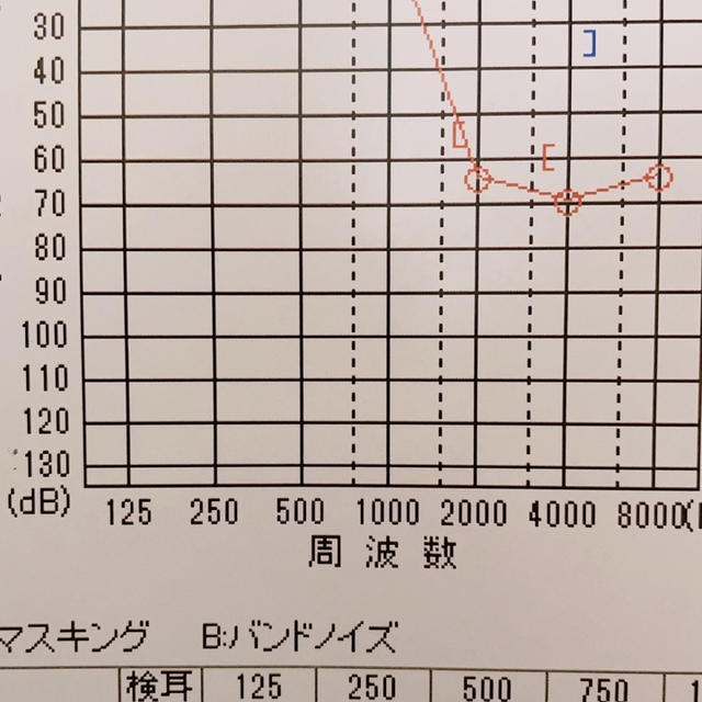 突発性難聴から3年と半年。聴力の経過