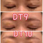 抜糸後3日目二重整形手術DT10日目までの経過レポ♡眼瞼下垂、二重切開、目の上のたるみ取り