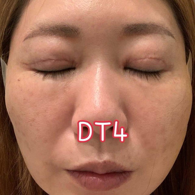 切開リフトDT4日目でやっと体調回復へ