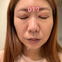 顔脂肪吸引経過＆シミ取りレーザーDT7日目レポ♡