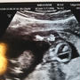 【私の不妊治療日記】 出生前診断、私は初期胎児超音波検査を受けました