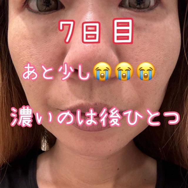 病院によって違う、レーザーの照射の回数と全顔シミ取りレーザー7日目のレポ