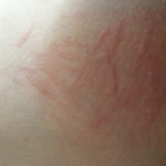 慢性蕁麻疹悪化中
