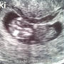 10w4d　絨毛膜下血腫＆予定日決定