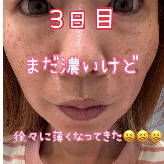 選んだレーザーの種類と♡41歳全顔シミ取りレーザー記録3日目＠ピコトリプル