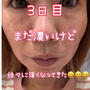 選んだレーザーの種類と♡41歳全顔シミ取りレーザー記録3日目＠ピコトリプル