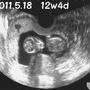 12w5d　12w妊婦検診(12w4d)　やっぱりハイリスク妊娠!!