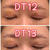 【美容整形経過レポ】抜糸6日目二重整形手術DT13日目まで♡眼瞼下垂、二重切開