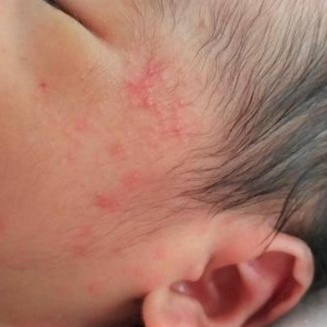 赤ちゃんの顔にブツブツが 妻と実践した乳児湿疹の対処法と効果があった乳液 By パパラさん レシピブログ 料理ブログのレシピ満載