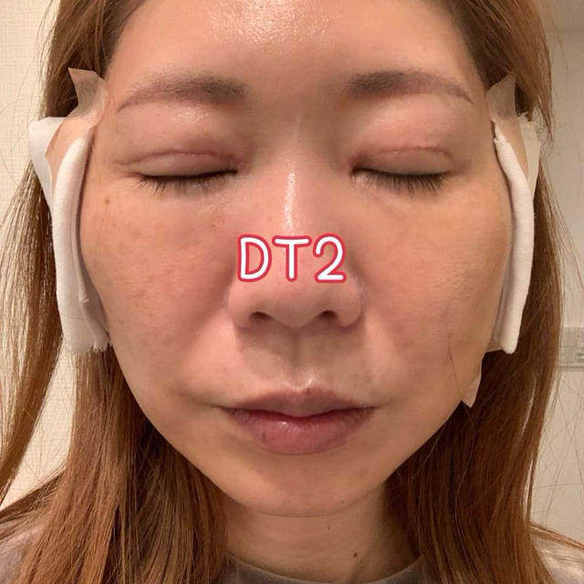 切開リフトDT2日目吐き気と下痢は止まるがさらなる悲劇