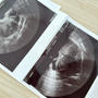 覚悟を決めての婦人科受診：子宮筋腫がわかるまでの経緯～体験談その⑪