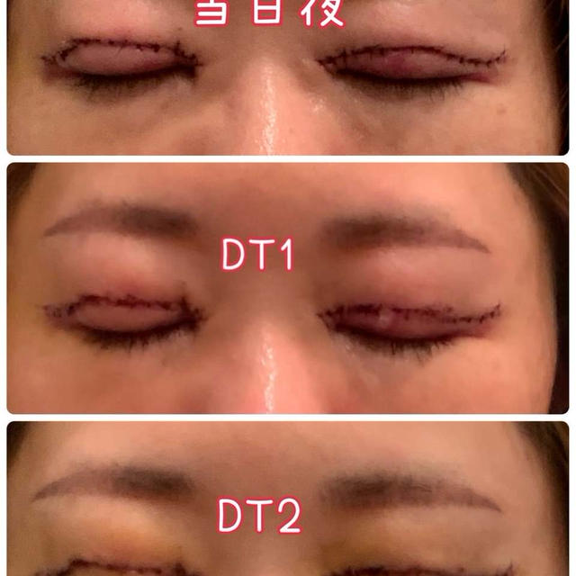 二重整形DT2日目レポ♡眼瞼下垂、二重切開、目の上のたるみ取り、脂肪取り