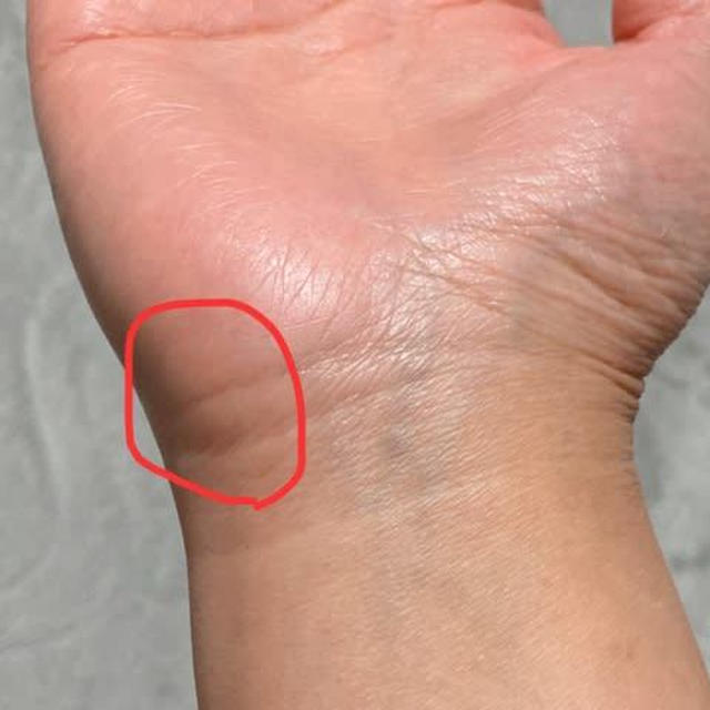 この痛みは腱鞘炎？？