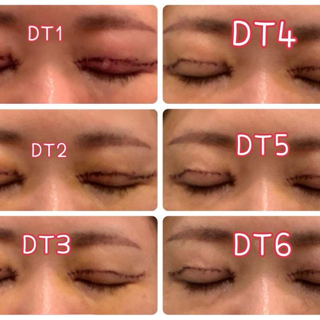 目元の脱脂・たるみ取り手術DT6日目レポ♡眼瞼下垂、二重切開、目の上のたるみ取り、脂肪