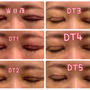 40代目の上のたるみ取り手術DT5日目レポ♡眼瞼下垂、二重切開、目の上のたるみ取り、脂肪取り