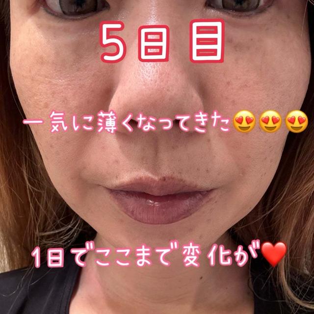 ピコレーザーの種類と違いと全顔シミ取りレーザー記録5日目のメイクはどれくらいゴマカセル？