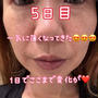 ピコレーザーの種類と違いと全顔シミ取りレーザー記録5日目のメイクはどれくらいゴマカセル？