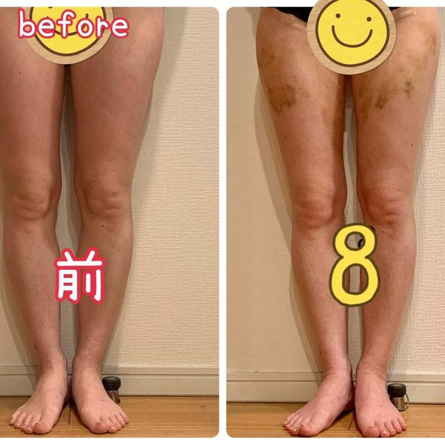 太ももの脂肪吸引で豊胸してどれくらい胸が大きくなったか