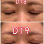 抜糸後2日目二重整形手術DT9日目までの経過レポ♡眼瞼下垂、二重切開、目の上のたるみ取り