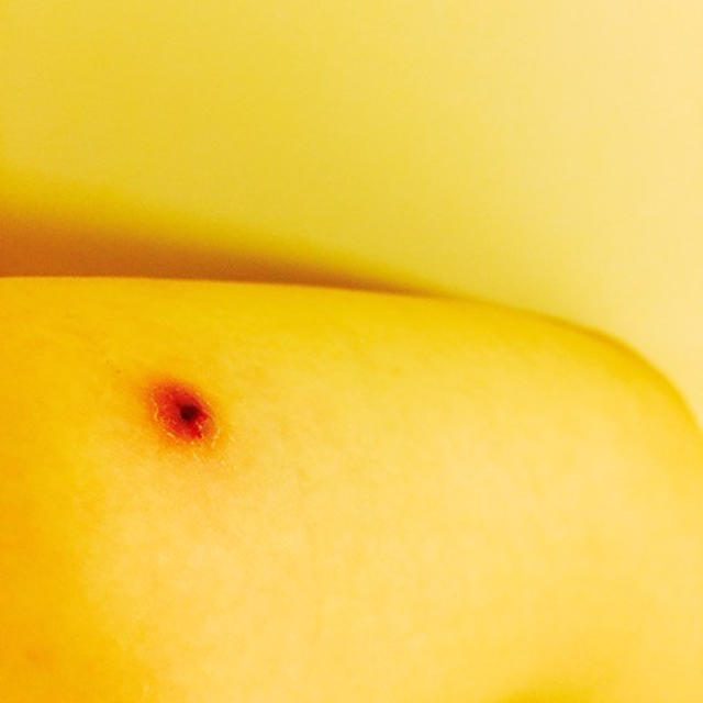 膿が出てきた(^_^;)