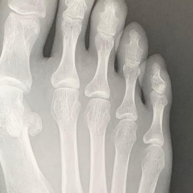 足の指を骨折したかなと思ったら