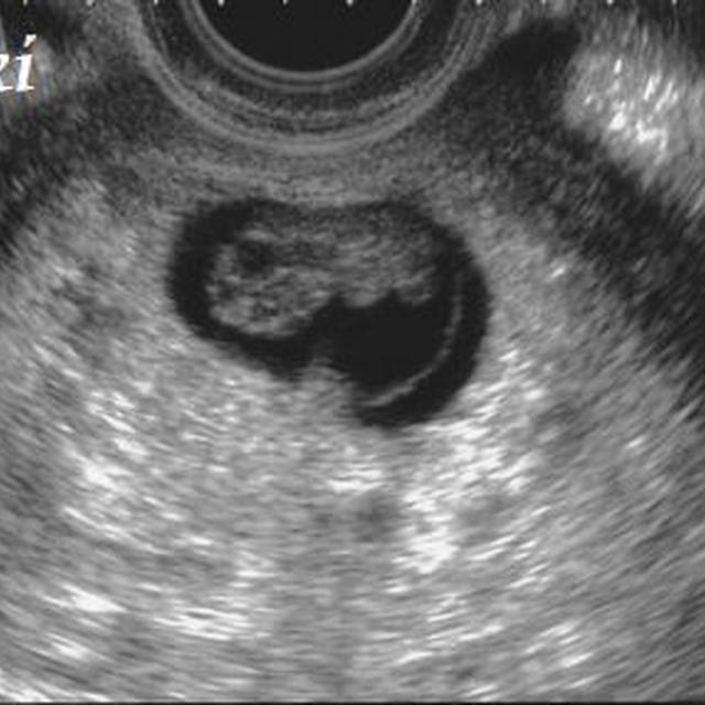8w4d　緊急転院決定