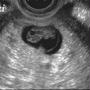 8w4d　緊急転院決定