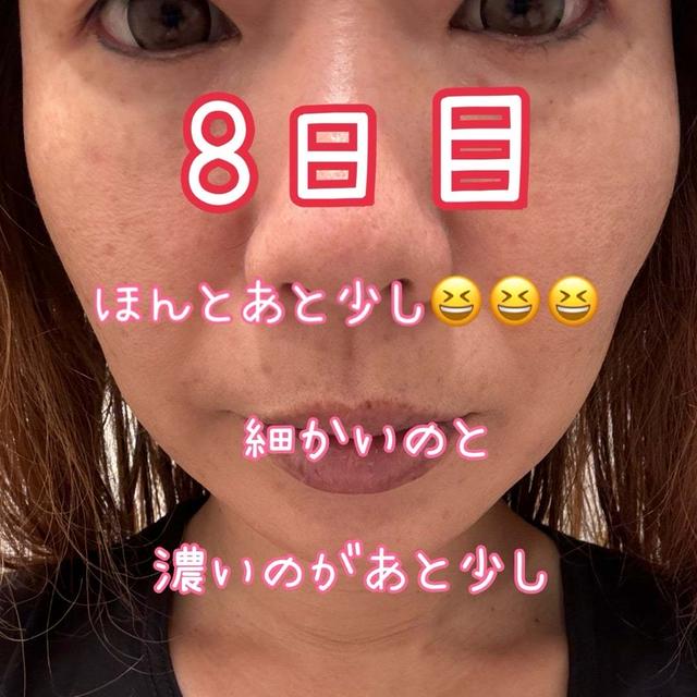 ダウンタイムを早めるためにした事と♡全顔シミ取りレーザー8日目のレポ