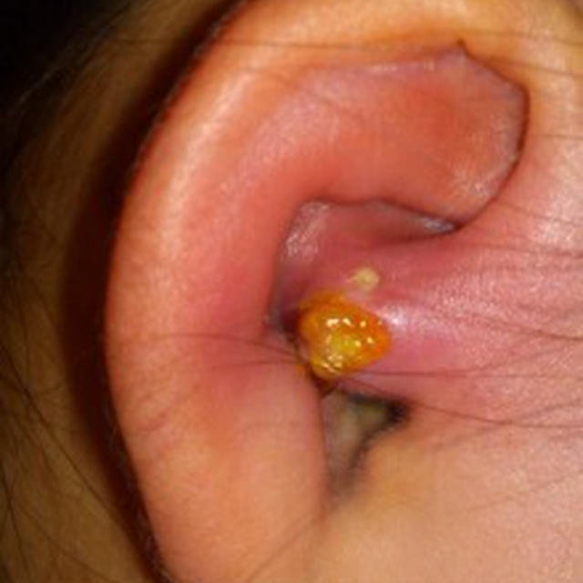 先天性耳瘻孔（じろうこう）摘出手術