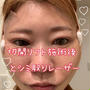 フェイスリフト（切開リフト）をしてきました！