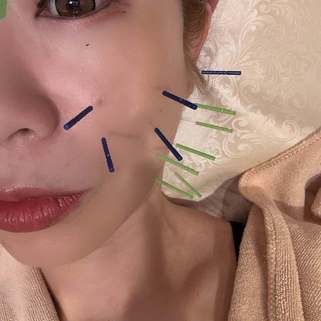 くすみ×むくみに最強♡破壊力半端ない！美容鍼