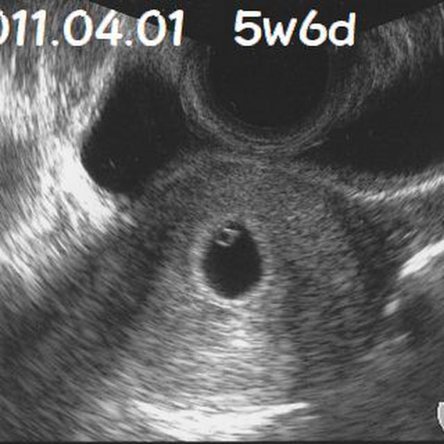 5w6d　エンジェルリング♪