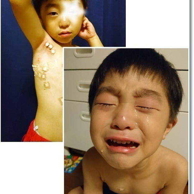 【水いぼ処置】もっと早く行けば良かった…と保育園暗黙の？ルール？？再び愛の不時着！