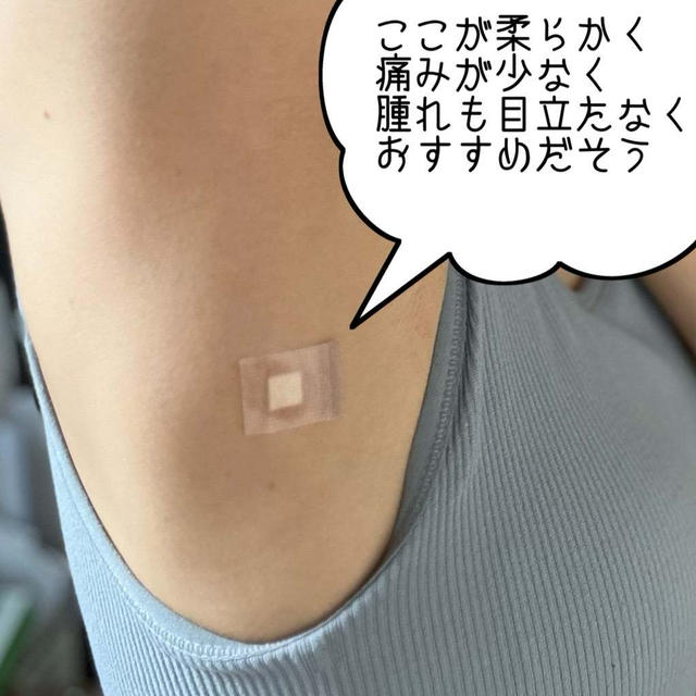 腫れた！プラセンタ注射、費用、診察の流れ。