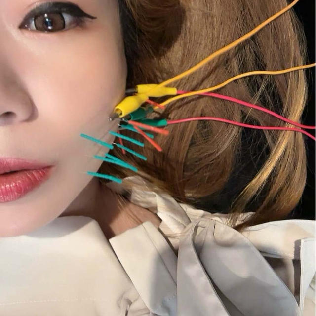 切開リフトだけじゃダメだった！顔のたるみの原因と美容鍼+EMS+小顔矯正へ