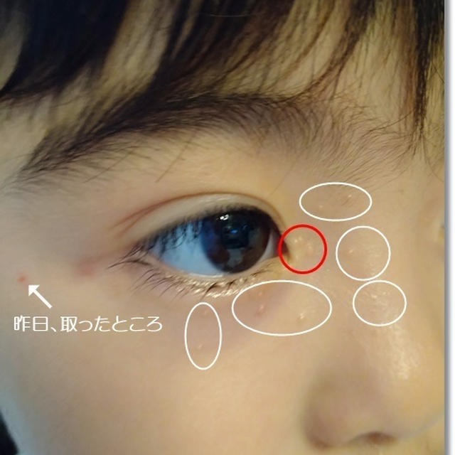 【水いぼ】顔に出来た水イボは一刻も早く取るべし！２歳児姫の水イボとの闘い…